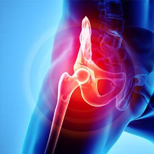 Hip Pain graphic for hip replacement surgery in Bedford