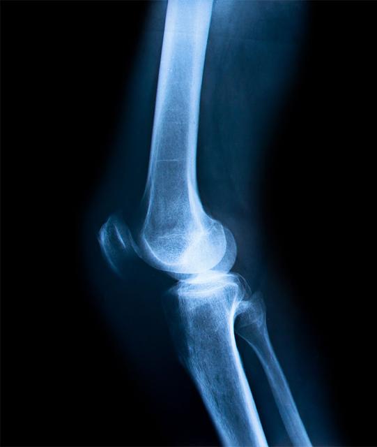 Xray of Knee. diagnostic for knee surgery.